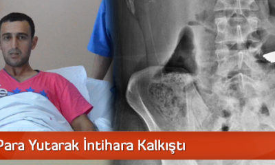 Madeni Para Yutarak İntihara Kalkıştı