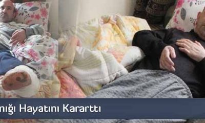 Soğuk Yanığı Hayatını Kararttı