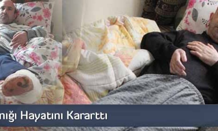 Soğuk Yanığı Hayatını Kararttı
