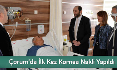 Çorum’da İlk Kez Kornea Nakli Yapıldı
