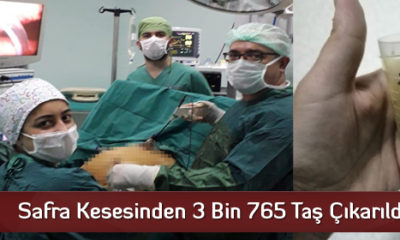 Safra Kesesinden 3 Bin 765 Taş Çıkarıldı