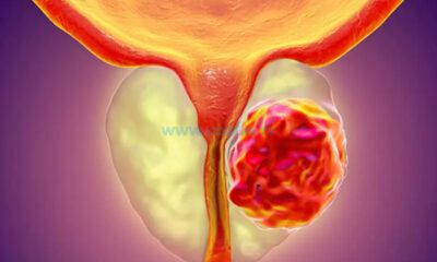 ‘Prostat Kanseri Riski 50 Yaş Üstünde Artıyor’