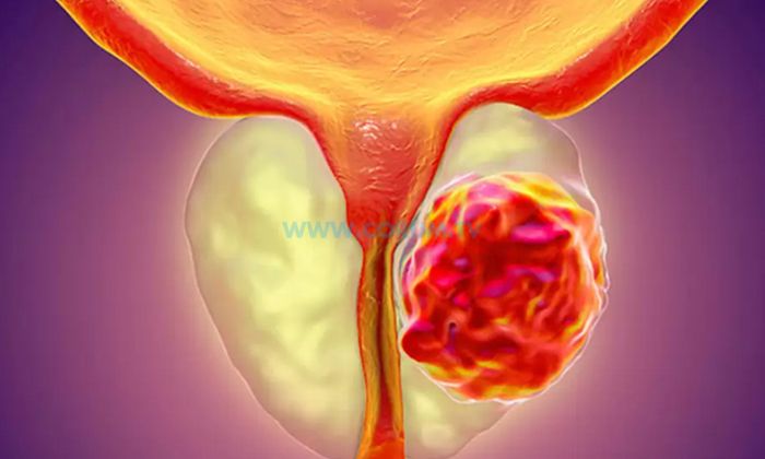 ‘Prostat Kanseri Riski 50 Yaş Üstünde Artıyor’