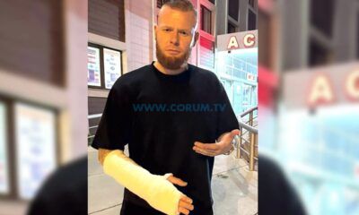 Sinirlenen Thomas Verheydt Kendini Sakatladı
